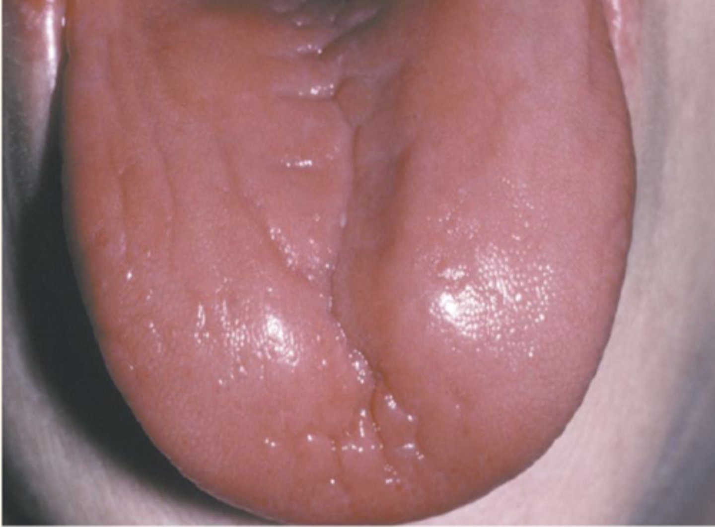 <p>Glossitis</p>