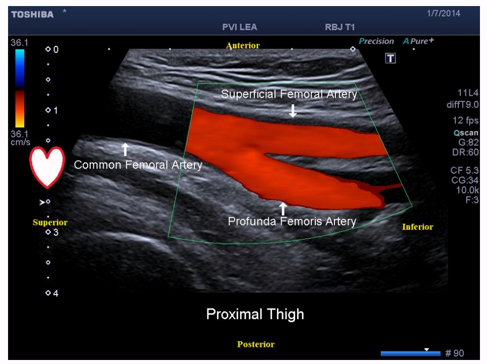<p>the flow in this femoral artery goes from</p>