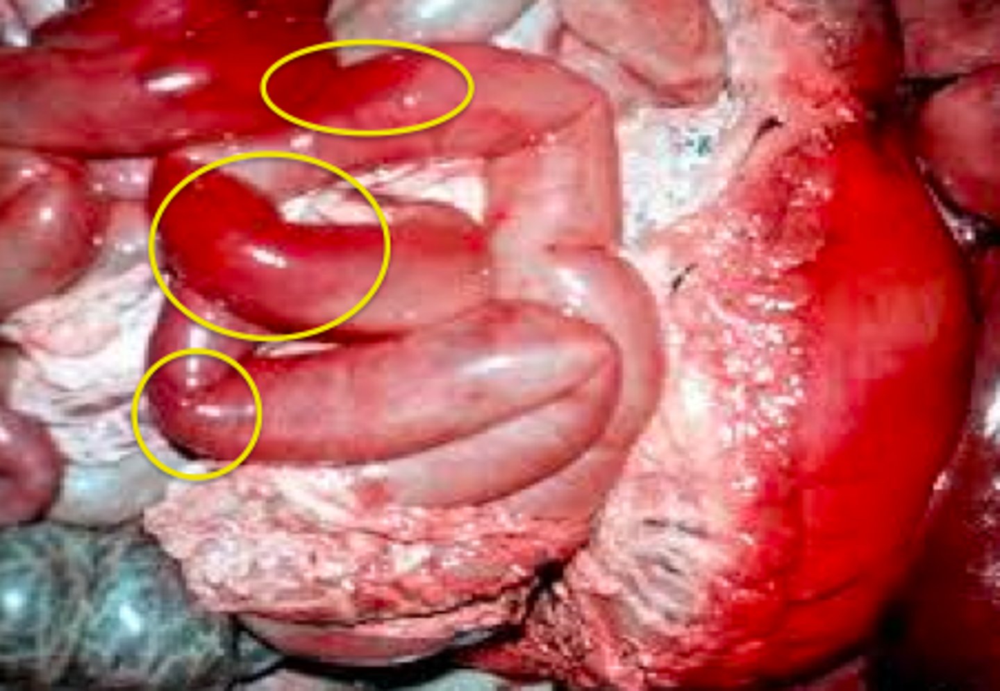 <p>reddish discoloration of tissue from lysed erythrocytes; Leakage of hemoglobin from blood vessels after death;</p>