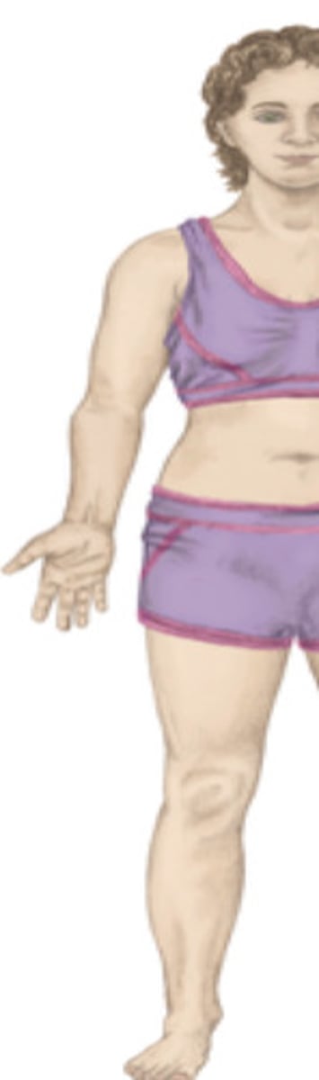 <p>An abnormal inward/medial deviation at the elbow</p>