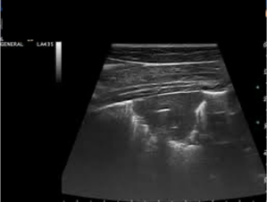 <p>AKP store husdyr blok 1 2024</p><p>Du tilkaldes til et stort stutteri med flere ældre føl (2-4 måneder) med feber og takypnø. På baggrund af ultralydsskanning, anamnese og kliniske fund, hvad er så den mest sandsynlige diagnose og hvordan vil du bekræftige den?</p><p>1 E. coli pneumoni, Bekræftigelse med blodkultur </p><p>2 EHV-1 infektion, Bekræftigelse med antistof-måling i serum </p><p>3 Rhodococcus-infektion. Bekræftigelse med bakteriologisk kultur af trachealaspirat </p><p>4 Strept. equi infektion, bekræftelse med blodkultur</p>