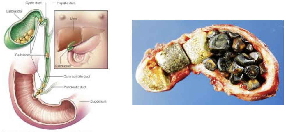 <p><strong><em>Biliary calculi</em></strong></p><ul><li><p><strong>EFFECT&nbsp;</strong></p><ul><li><p>Can obstruct flow of bile from gallbladder&nbsp;</p></li><li><p>Painful while gallbladder contracts against sharp crystals</p></li></ul></li><li><p><strong>CAUSE</strong></p><ul><li><p>Too much cholesterol or too few bile salts&nbsp;</p></li></ul></li></ul><p></p>