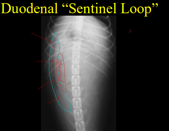 <ul><li><p><strong><u>Dogs</u></strong>: right lateral most abdominal wall</p></li><li><p><strong><u>Cats</u></strong>: more midline</p></li><li><p><strong>“Sentinel loop” sign</strong></p><ul><li><p><strong><u>Pancreatitis </u></strong>and 2dry functional ileus</p><ul><li><p><strong>not sensitive</strong></p></li></ul></li><li><p><strong>mildly gas distended</strong> on<strong> both views</strong></p></li></ul></li><li><p><strong>Wall diseases</strong></p><ul><li><p>Lymphosarcoma, adenocarcinoma, leiomyosarcoma<br></p></li></ul></li></ul><p></p>