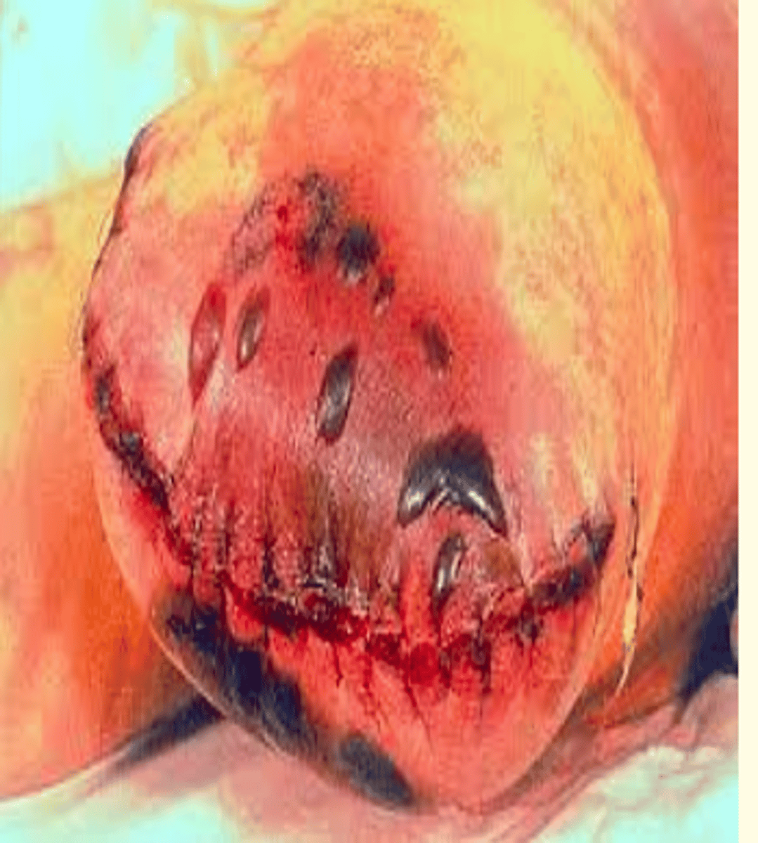 <p>Clostridium perfringens</p>