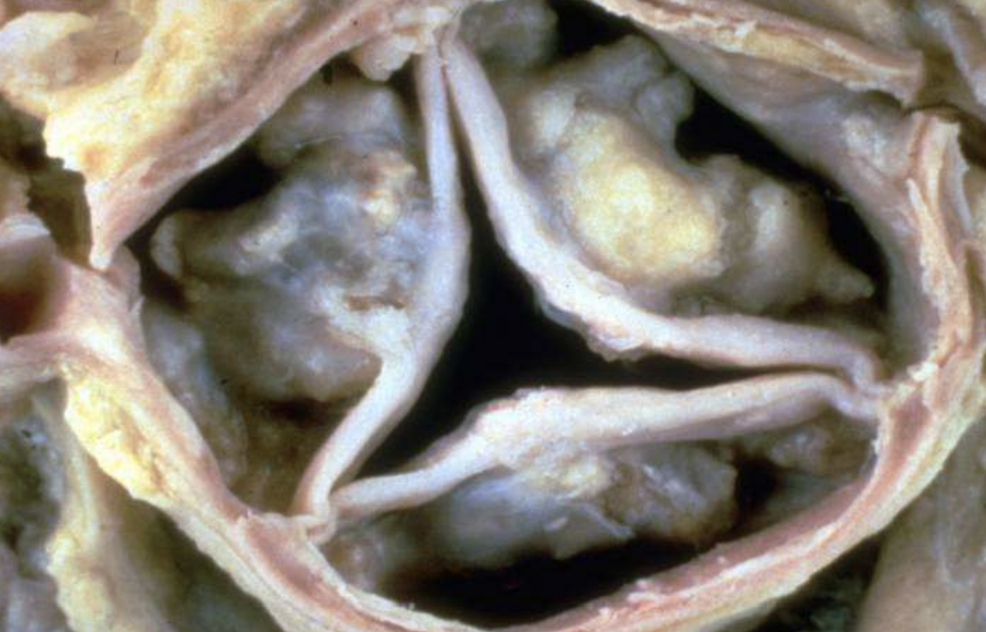 <p>Calcified Aortic/Mitral Stenosis</p>