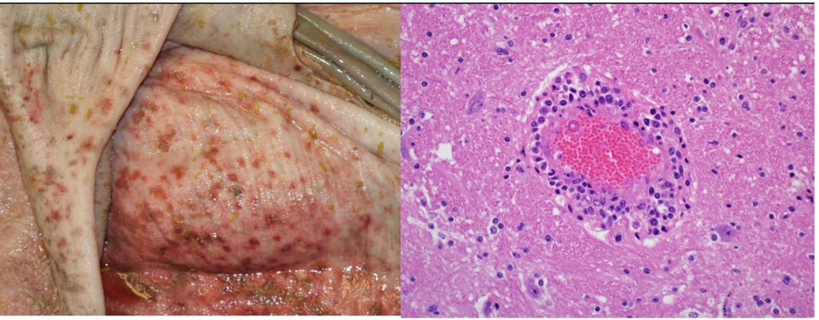 <p>What is the etiology?</p><p>A-Foot and mouth disease virus</p><p>B-Varicellovirus bovinealphal</p><p>C-Papular stomatitis virus</p><p>D-Ovine herpesvirus type 2</p>