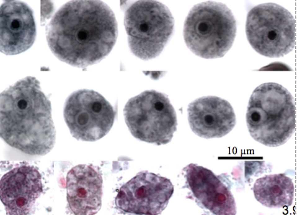 <p>Name: Iodamoeba butschlii</p><p class="p1">Stage: trophozoite</p><p class="p1">*Single nucleus /Large endosome</p><p class="p1"><span style="font-size: calc(var(--scale-factor)*32.02px);"><span>*large cytoplasmic vacuole</span></span></p>