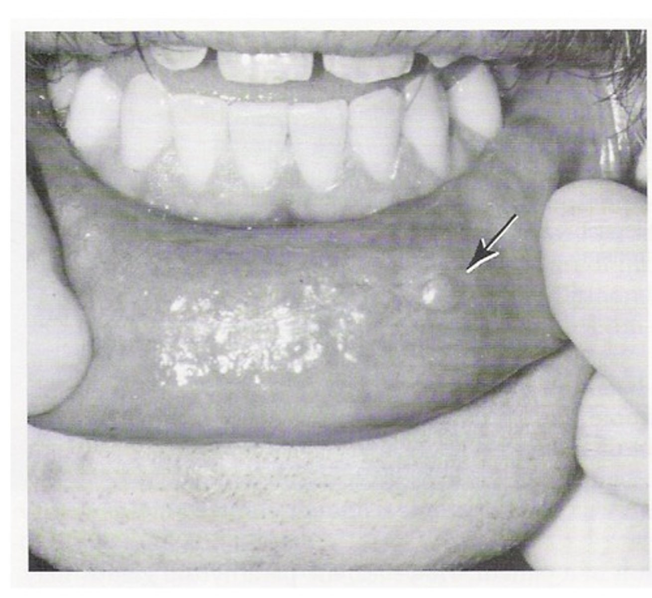 <p>Minor salivary gland duct injured, mucous salivary secretion into adjacent connective tissue, causing swelling in the tissue.</p>