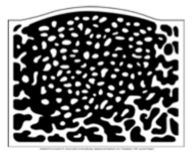<p>A granular or pebbled radiopacity that resembles pulverized glass. Often said to resemble the appearance of texture of an orange peel.</p>