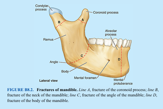 <p>A broken mandible usually involves two fractures, which frequently occur on opposite sides of the mandible. Therefore, if one fracture is observed, a search should be made for another (e.g., a hard blow to the jaw often fractures the neck and body of the mandible in the region of the opposite canine tooth). Fractures of the coronoid process of the mandible are uncommon and usually single (Fig. B8.2). Fractures of the neck of the mandible are often transverse and may be associated with dislocation of the temporomandibular joint (TMJ) on the same side. Fractures of the angle of the mandible are usually oblique and may involve the bony socket or alveolus of the 3rd molar tooth (Fig. B8.2, line C). Fractures of the body of the mandible frequently pass through the socket of a canine tooth (Fig. B8.2, line D).</p>