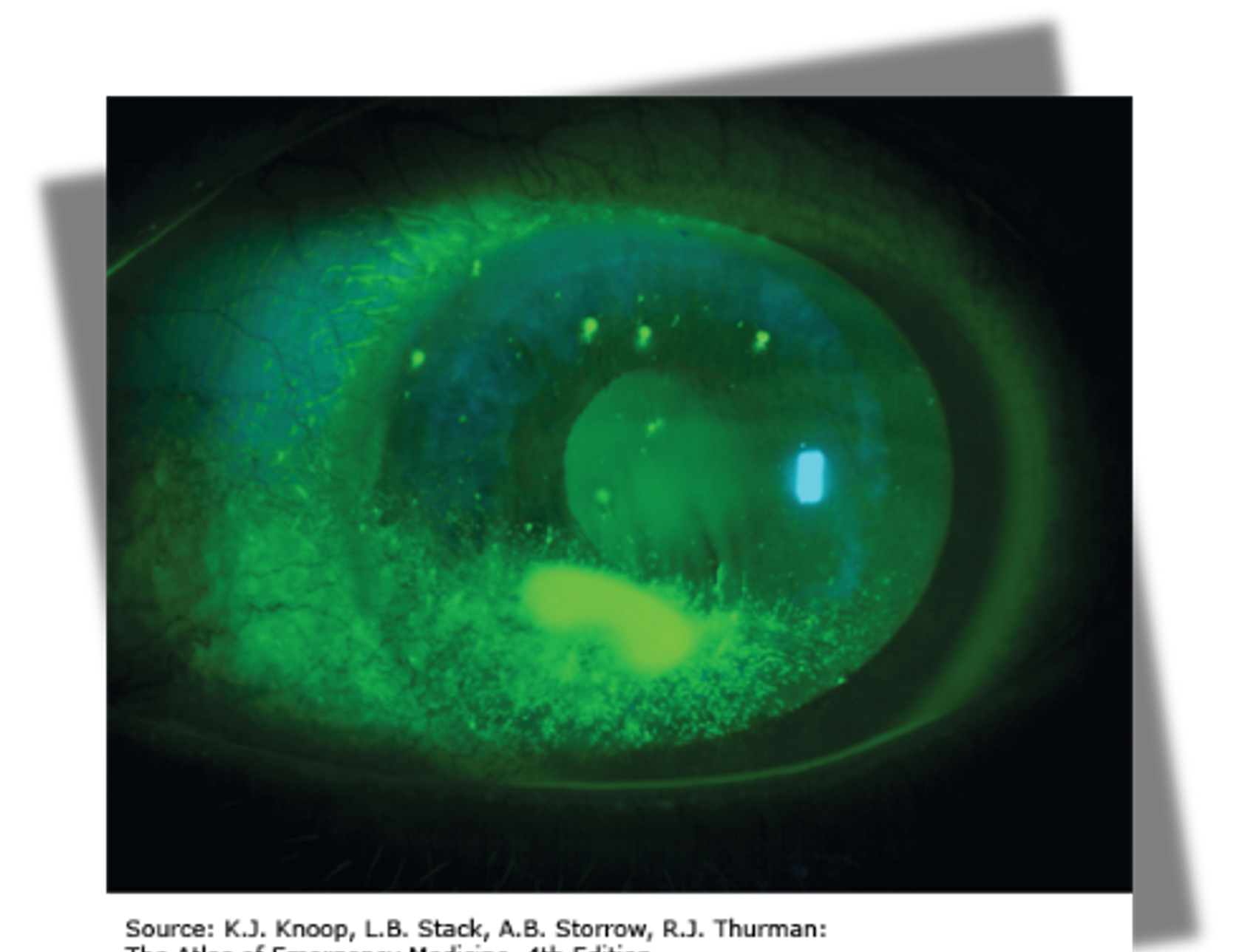 <p>positive uptake w/ cobalt blue light; FB sensation, severe pain, photophobia</p>