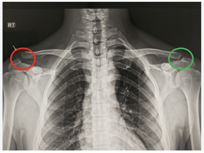 <p>Trauma in upper shoulder resulting in a partial or complete tear of the AC.</p>