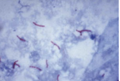 <p>de zuurvaste Koch-bacillen kleuren rood</p>