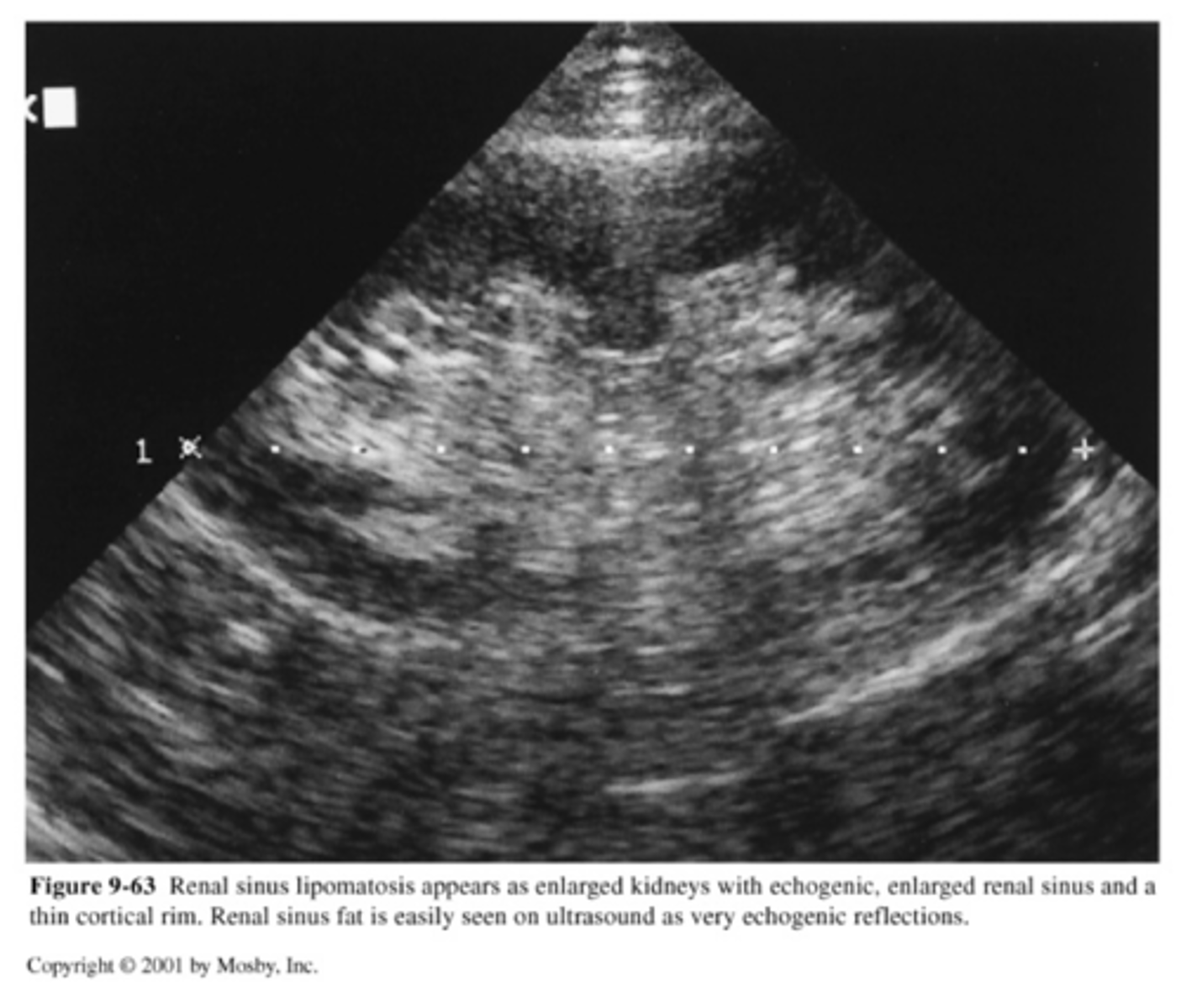 <p>-smaller kidneys</p><p>-highly echogenic enlarged renal sinus</p><p>-thin cortical rim (&lt;5mm) is abnormal</p>
