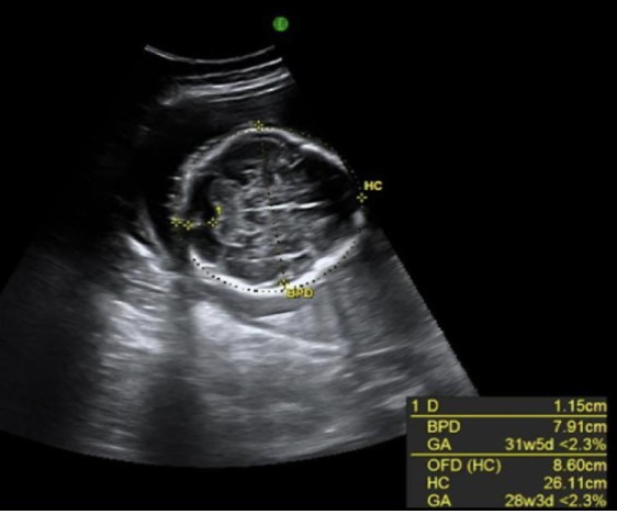 <p>which describes a rounded head w/cephalic index &gt;85%</p><p>a) bra<strong>dy</strong>cephaly</p><p>b) dolicephaly</p><p>c) bra<strong>chy</strong>cephaly</p><p>d) microcephaly</p>