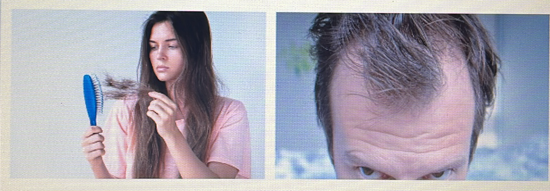 <p>HAIR DISORDER</p><p><span style="font-family: Calibri, sans-serif"><strong>Telogen effluvium</strong>: Loss of hair during its rest phase. It typically shows up a few months after your body goes through something stressful or from hormonal changes.</span></p>