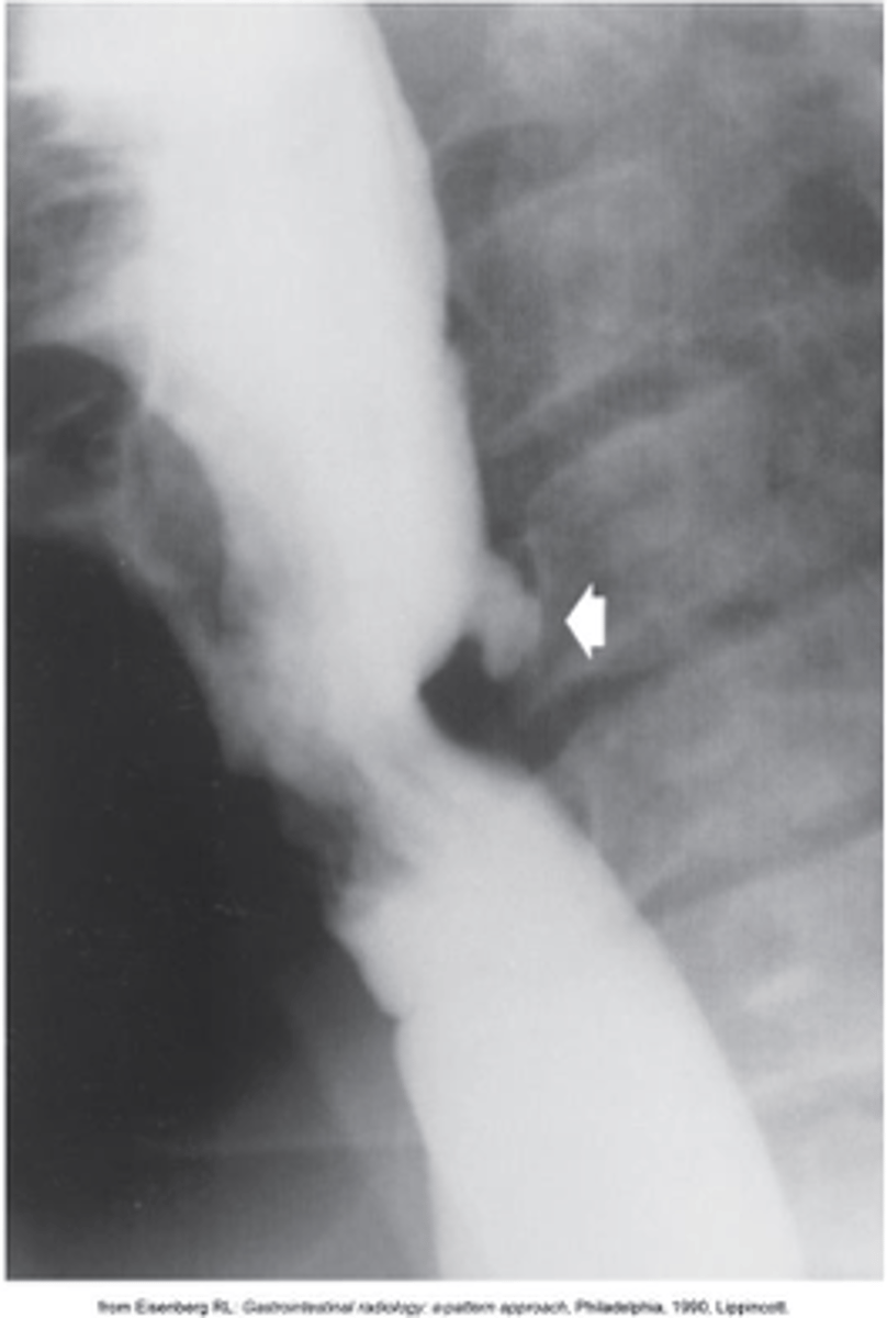 <p>What is Zenkers Diverticula?</p>