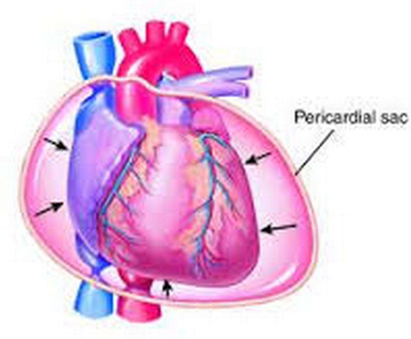<p>fluid accumulation in the pericardium that compresses the heart</p>