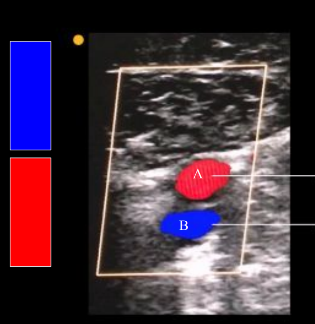 <p>T/F: we can only tell flow direction in long/sag vessel orientation, not transverse</p>