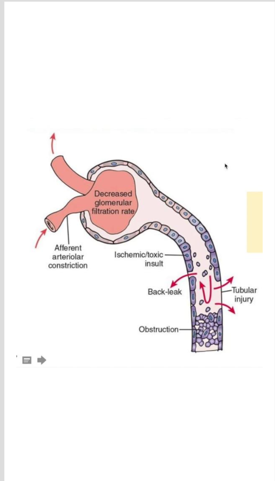 <p><strong>Acute Tubular Necrosis</strong></p><ul><li><p>results from ischemia, nephrotoxins, or sepsis</p></li><li><p>severe ischemia causes disruption in the basement membrane</p></li><li><p>nephrotoxic agents cause necrosis of tubular epithelial cells</p></li><li><p>potentially reversible</p></li></ul><p></p><p>If you know the cause —&gt; stop the cause (TREATMENT)</p><p></p>