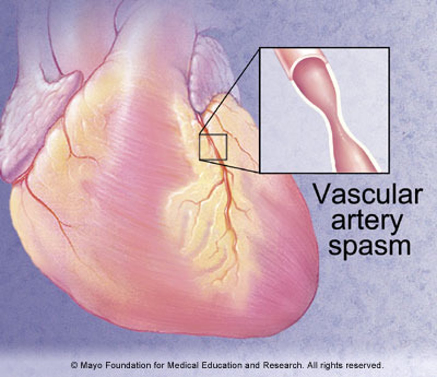<p>due to acute coronary vasospasm </p><p>- occurs at rest or sleep </p><p>- treated with vasodilators, not anticoagulants </p>