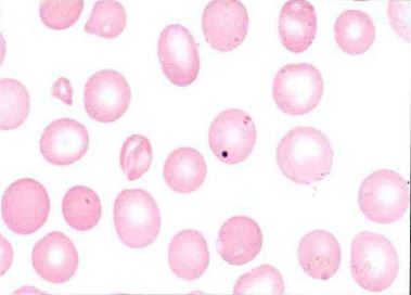 <p>What is the composition of the inclusion seen in this RBC?</p><p>a DNA</p><p>b RNA</p><p>c Iron</p><p>d denatured hemoglobin</p>