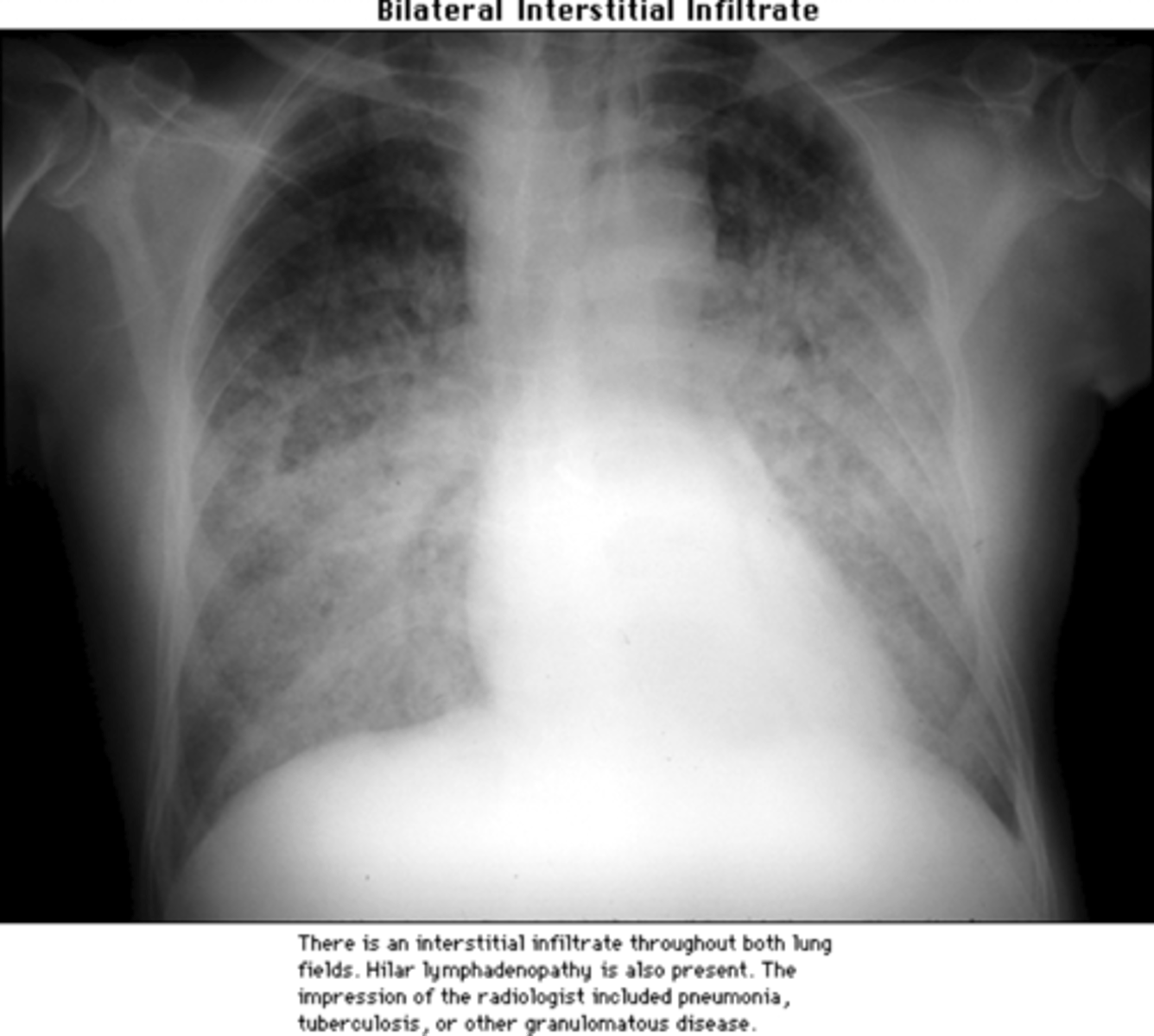 <p>notice how it looks like "fog" or a general heaviness throughout the lung fields</p><p>- heart borders are still well defined</p>