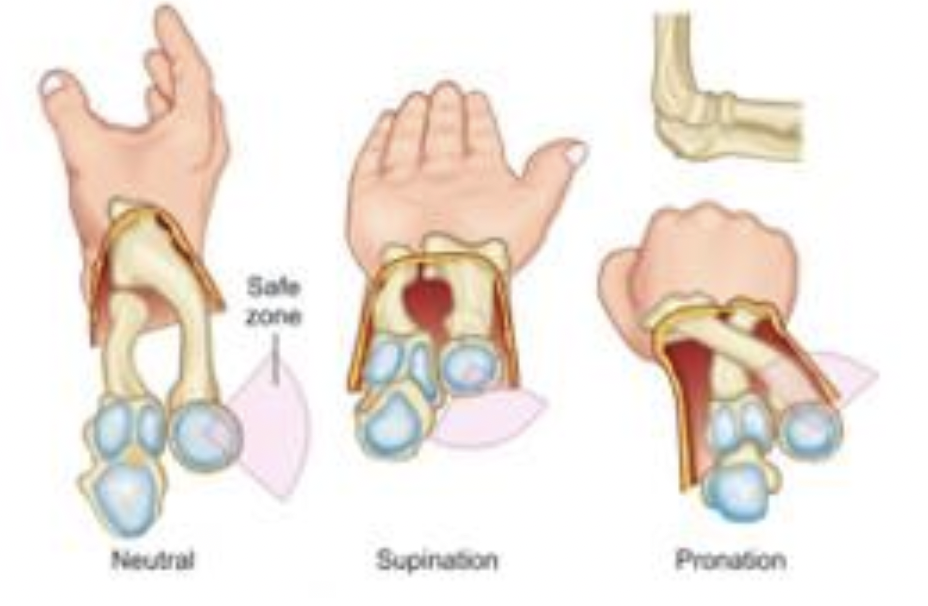 <p>• Partie de la tête radiale qui ne s’articule pas avec l’ulna</p><p>• Arc de cercle d’environ 110º ; approximativement 65º en antérieur et 45º en postérieur</p><p>• Position neutre, supination et pronation de l’avant-bras</p><p>• Ostéosynthèse (plaques et vis) post-fracture de la tête radiale ; protection du nerf interosseux postérieur</p><p>• Postéro-latérale en supination et antérieure en pronation </p><p>• Zone où le cartilage est le plus mince</p>