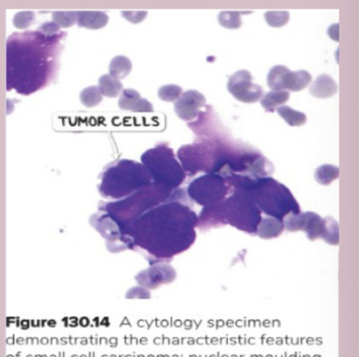 <p>-biopsy= large cells with limited cytoplasm and nuclear moulding </p><p>Staging: </p><p>-CT + contrast scan chest and PET scan </p><p>-neuro or adenocarcinoma &gt;3cm: MRI of the head w/o and w contrast </p><p>-CT abdomen </p>