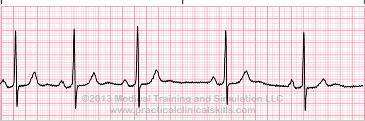 <p>HR:60-100 bpm</p><p>P-wave:1 per QRS complex</p><p>Regularity: irregular</p><p>PR Interval:Normal</p><p>QRS Duration: Normal</p><p></p>