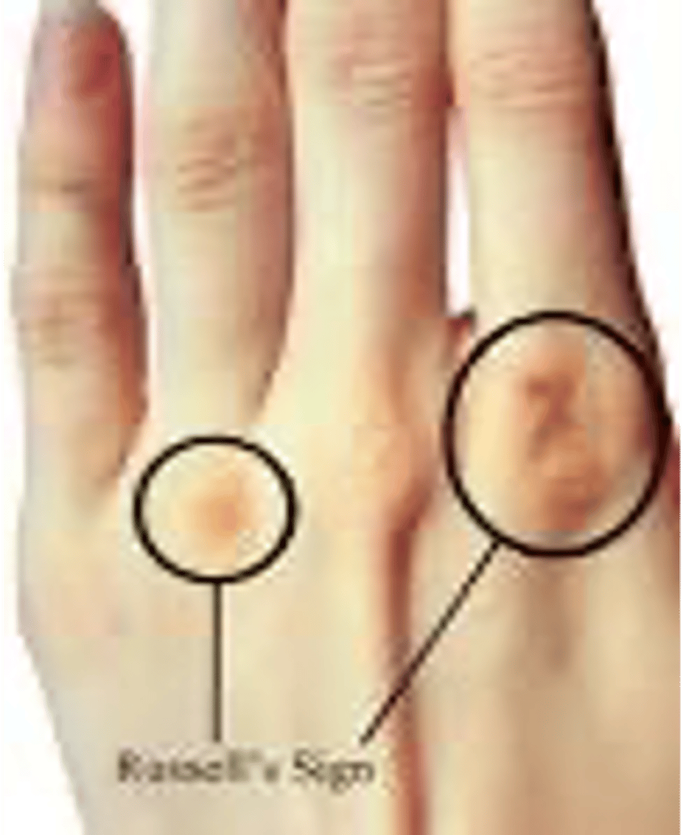 <p>Similar to AN as well as:</p><p>Oral and Dental issues: parotid gland enlargement, periodontal disease and dental caries</p><p>Russell's sign (dominant hand - cause of self induced vomiting)</p>