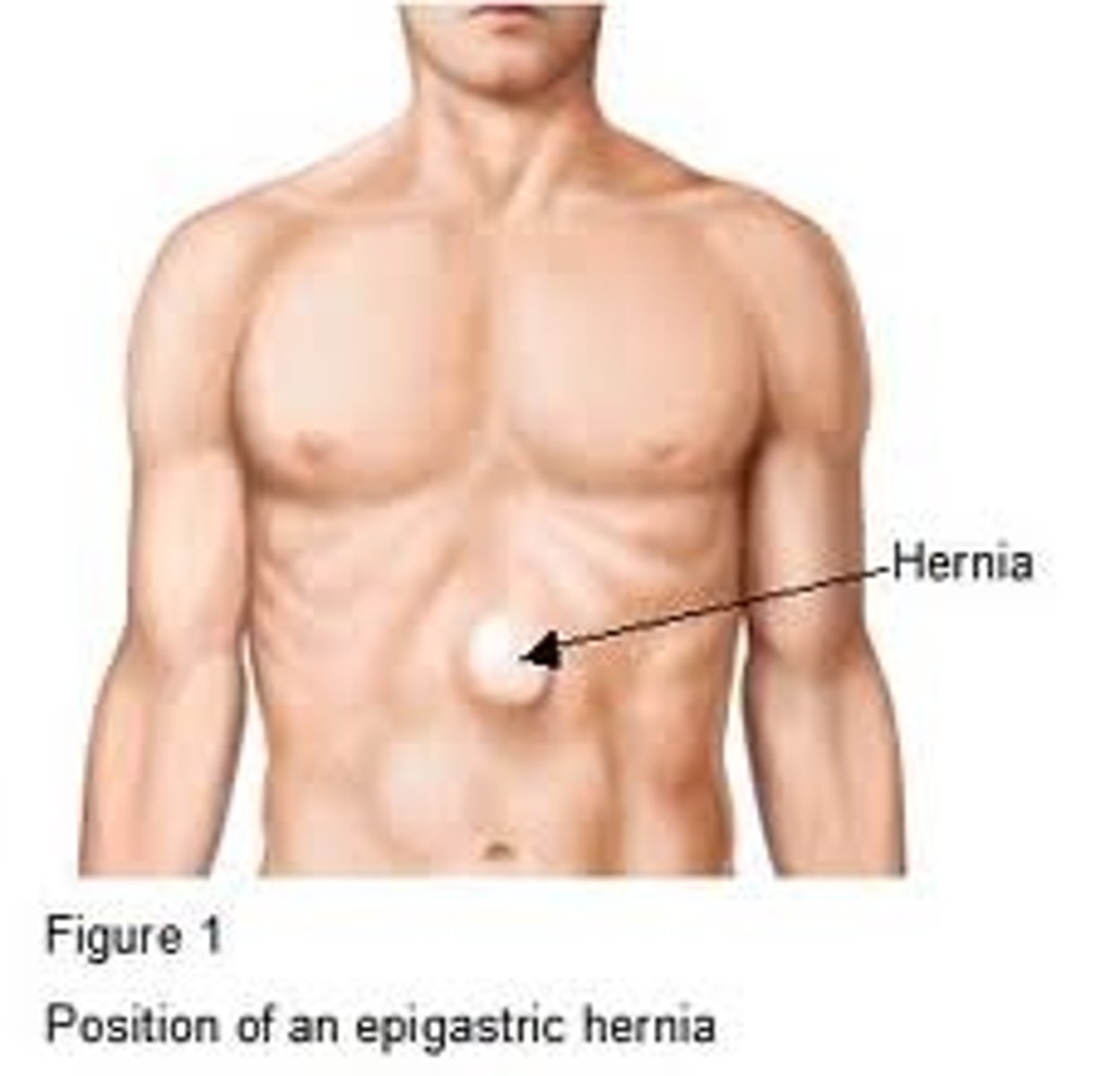 <p>Protrusion of abdominal structures presents as a small, fatty nodule at epigastrium in midline, through the linea alba.</p><p>Usually one can feel it rather than observe it. May be palpable only when standing.</p>