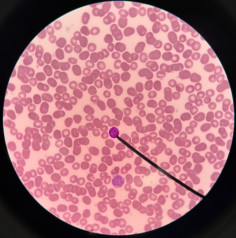 • Leukocyte and granulocyte.

• Appears with very large and prominent blue-stained cytoplasmic granules. Has a bilobed nucleus.

• Attracted to areas of tissue damage and promotes inflammation.

• Least abundant leukocyte.

• Count increased by allergies or leukemia.

• Count decreased by stress, hypothyroidism, and pregnancy.