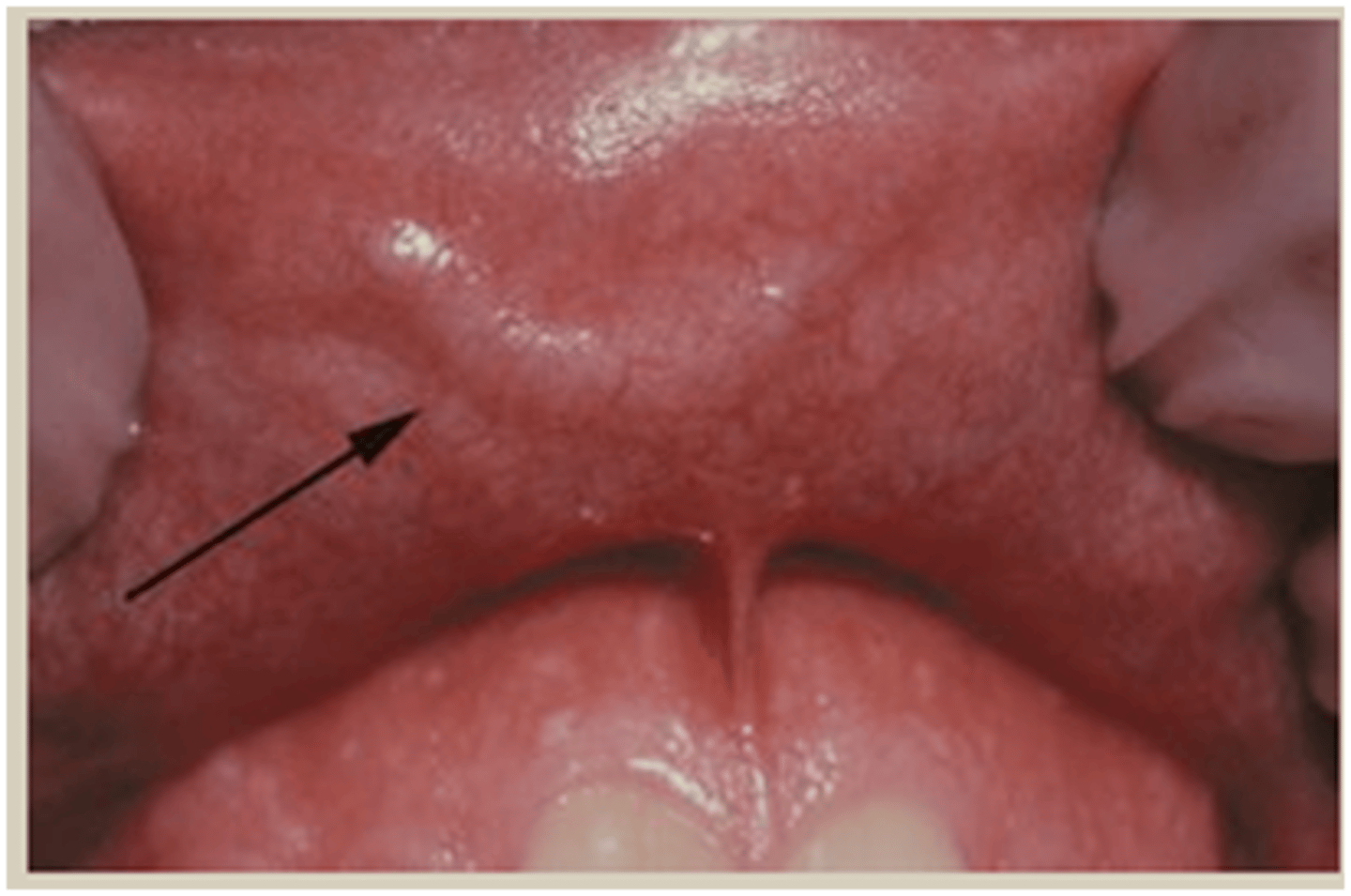 <p>• Common vascular anomaly</p><p>• A main arterial branch extends</p><p>up into the superficial</p><p>submucosal tissues without a</p><p>reduction in its diameter</p><p>• Seen more frequently in older</p><p>adults</p>