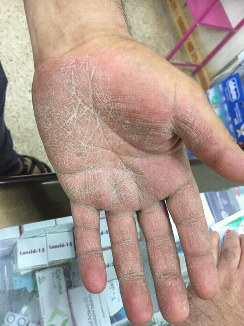 <p>PP: fungal infection of palms on hands</p><p>E: dermatophytes<br>primary infection→rare</p><p>CM: blisters on palms/fingers→single scale patch→infected nails</p><p>TX: topical antifungals<br>PO antifungals</p>