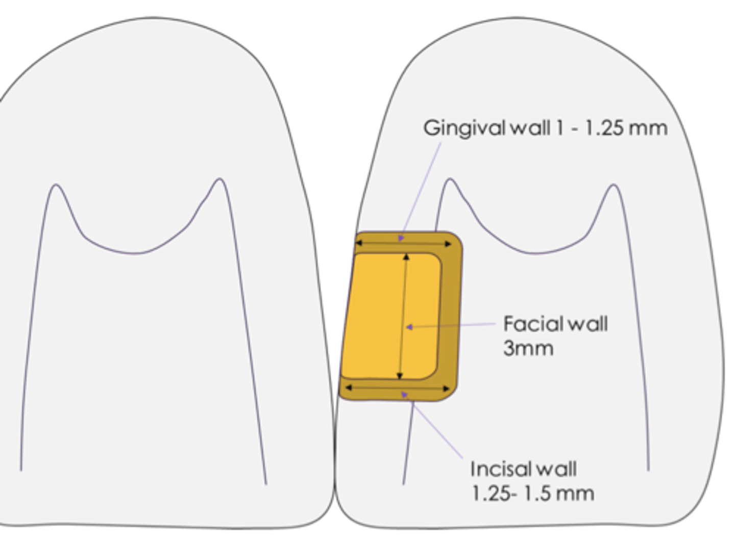<p>Lingual approach</p><p>1. gingival</p><p>2. incisal margin</p><p>3. marginal ridge</p><p>4. access</p><p>5. face each other</p><p>6. contact point</p><p>7. facial contact</p><p>8. 1 mm FL</p><p>9. 1.5 mm axially</p>