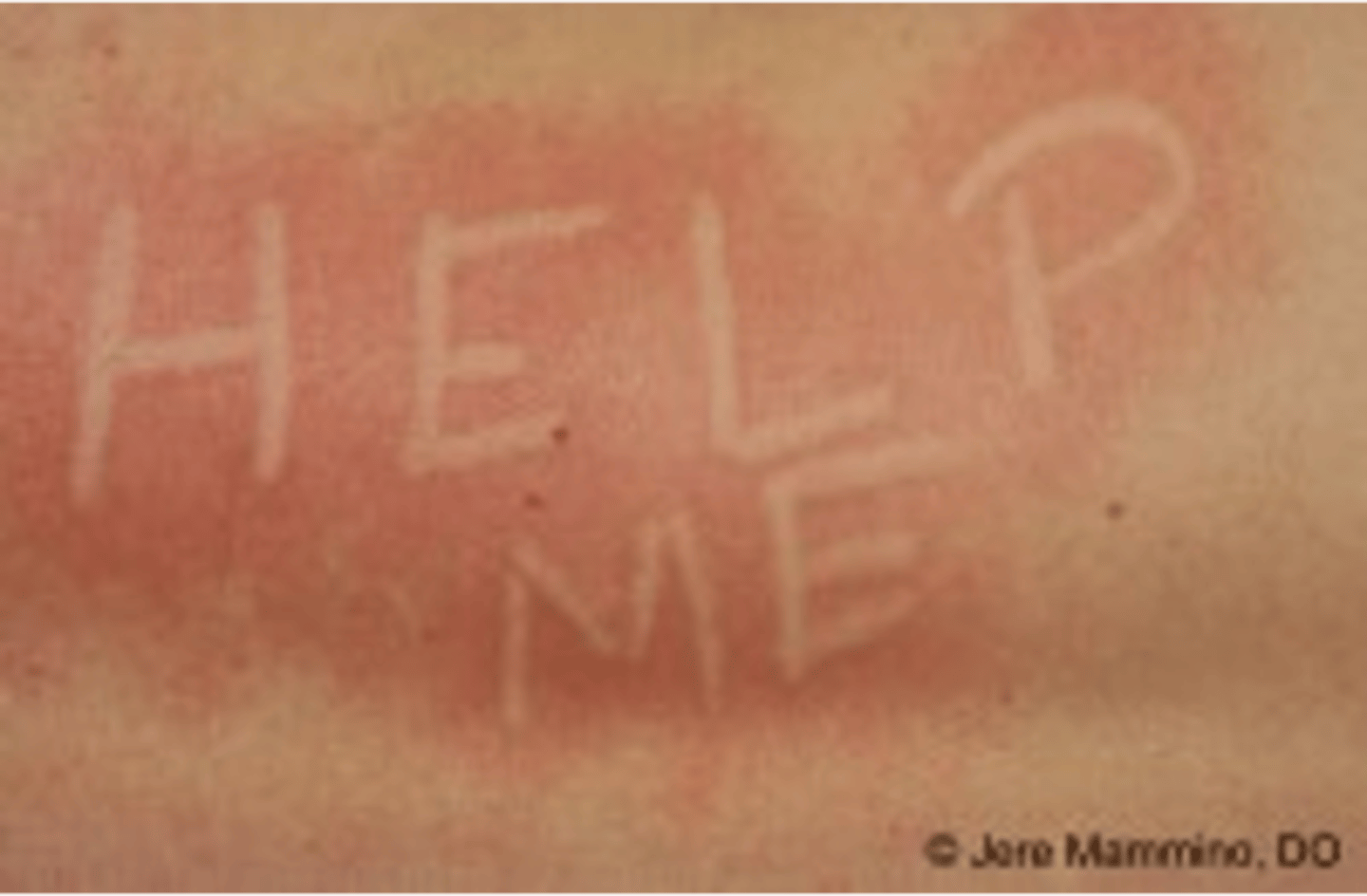 <p>_______________:</p><p>•Gentle rubbing or stroking of the lesions, is followed by local itching, erythema and weal formation within 2-5 min</p>