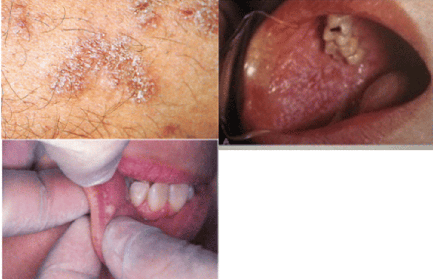 <p>Papule</p><p>It is a small bump.</p><p>*picture is of Linhen planus</p>