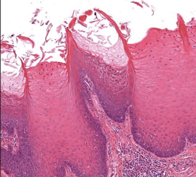 <ul><li><p>Forma de cono y altamente queratinizadas</p></li><li><p>Las más abundantes</p></li><li><p>Son responsables de la sensación de fricción y ayudan a manipular alimentos (agarre mecanico)</p></li><li><p><span style="color: red">No tienen botones gustativos </span>por eso no perciben sabores</p></li><li><p>Ubicados en toda la superificie dorsal de la lengua</p></li></ul><p></p>