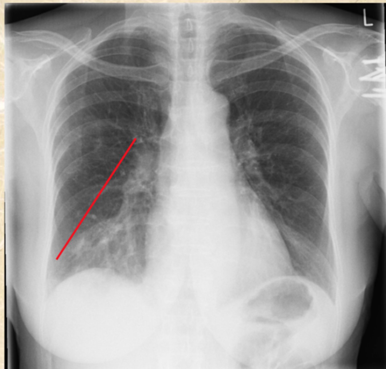 <p>What does this CXR show?</p>