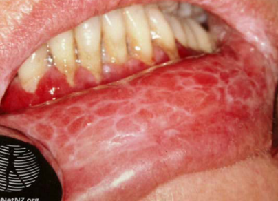 <p>a chronic inflammatory condition affecting the mucous membranes, characterized by white patches and lesions. </p>