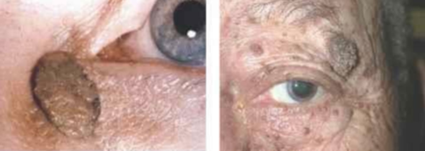 <p>basal epithelial cell tumor consisting of hyper-keratinized epithelium = well-demaracted, greasy, stuck-on appearance w/ slight elevation</p>