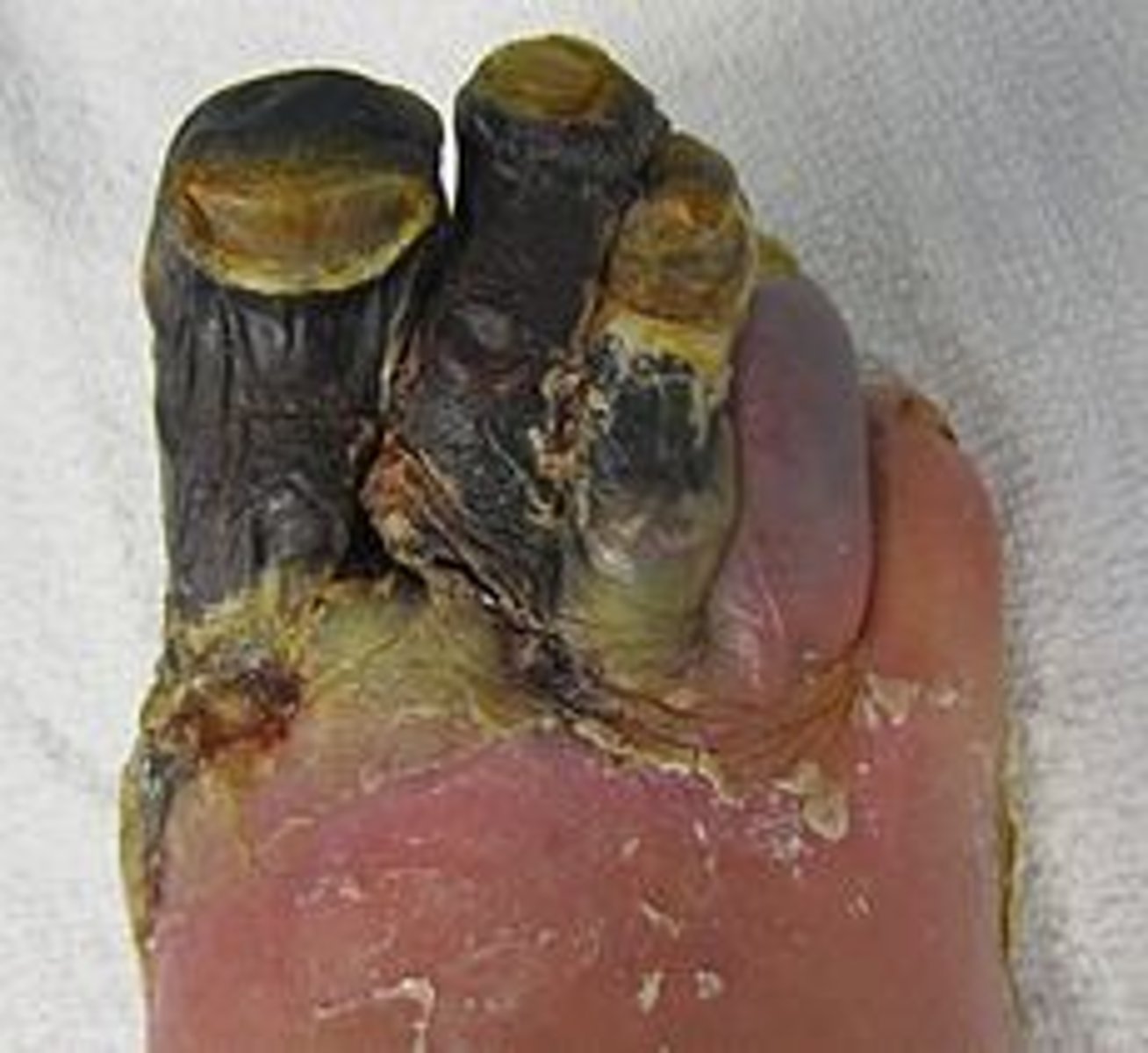 <p>Death of tissue (necrosis). Appears black and can spread. (Tx: Amputation)</p>