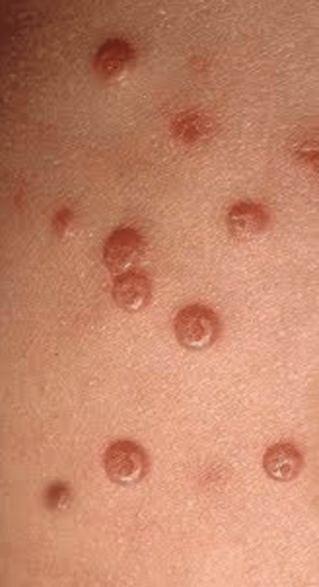 <p>Mollusca Contagiosum</p>