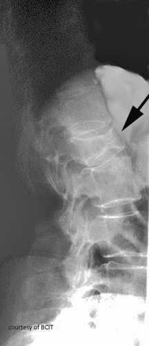 <p>What is the typical mechanism for a Chance fracture (Traumatic Fracture of Spine/ Seatbelt syndrome)?</p>