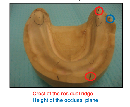 <p>- Crest of the residual ridge</p><p>- Determine the bucco-lingual placement of posterior teeth</p><p>- The central fossae of the premolar and molar denture teeth are placed directly over the crests of the mandibular residual ridges</p>
