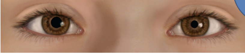 <p>Unequal Pupil Size</p>