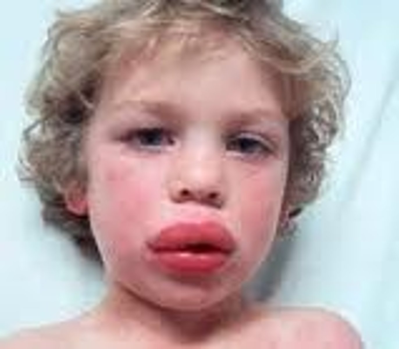 <p>swollen lips</p><p>anaphylaxis</p>