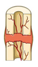 Blood vessels that are ruptured during the break swell to form a mass called a hematoma. This mass forms between the broken bones. This clotting reduces the blood supply to many of the cells in the area of injury, and as a result, these cells die.