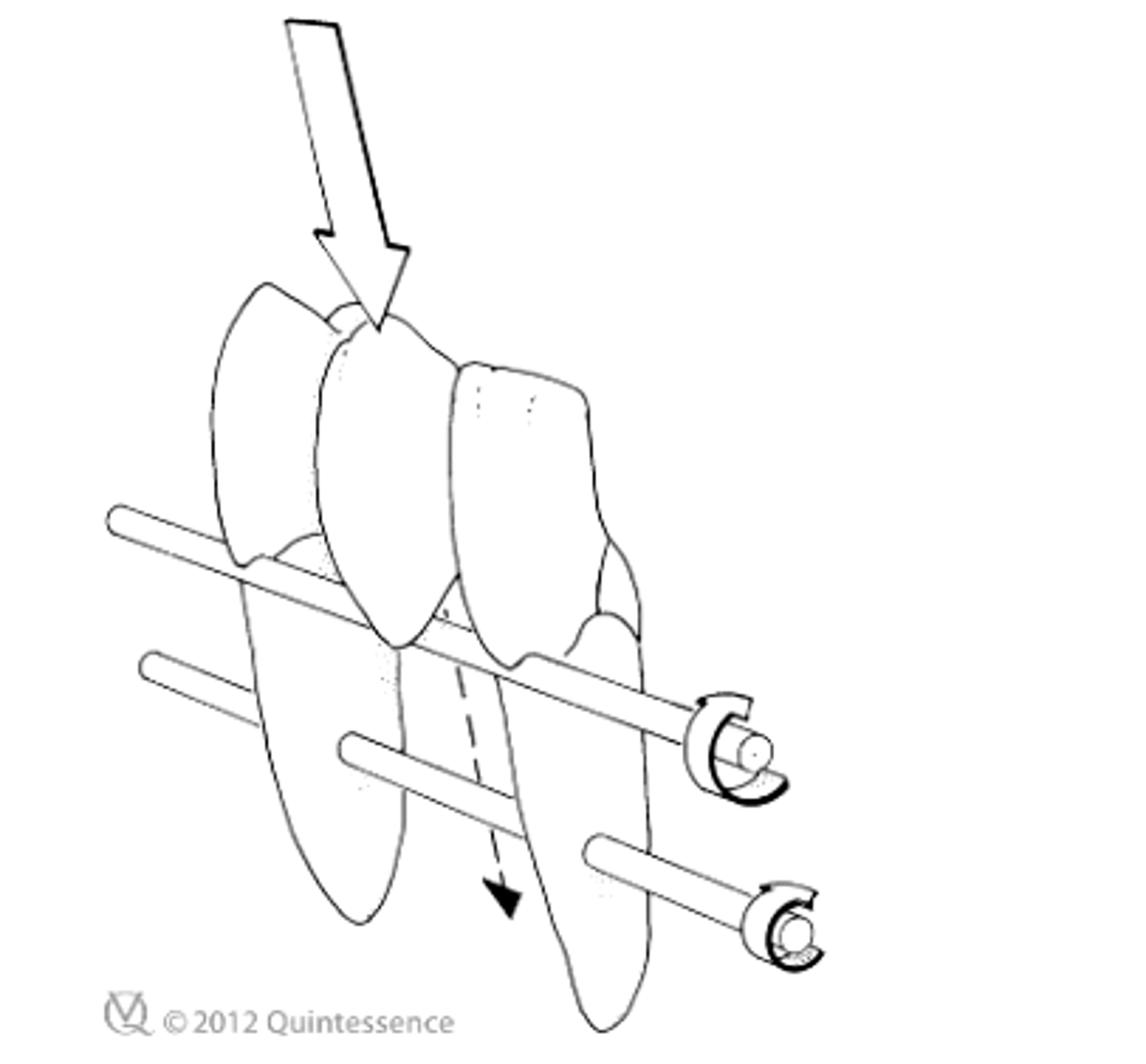 <p>forces are directed inward and the pontic is closer to the interabument axis</p>